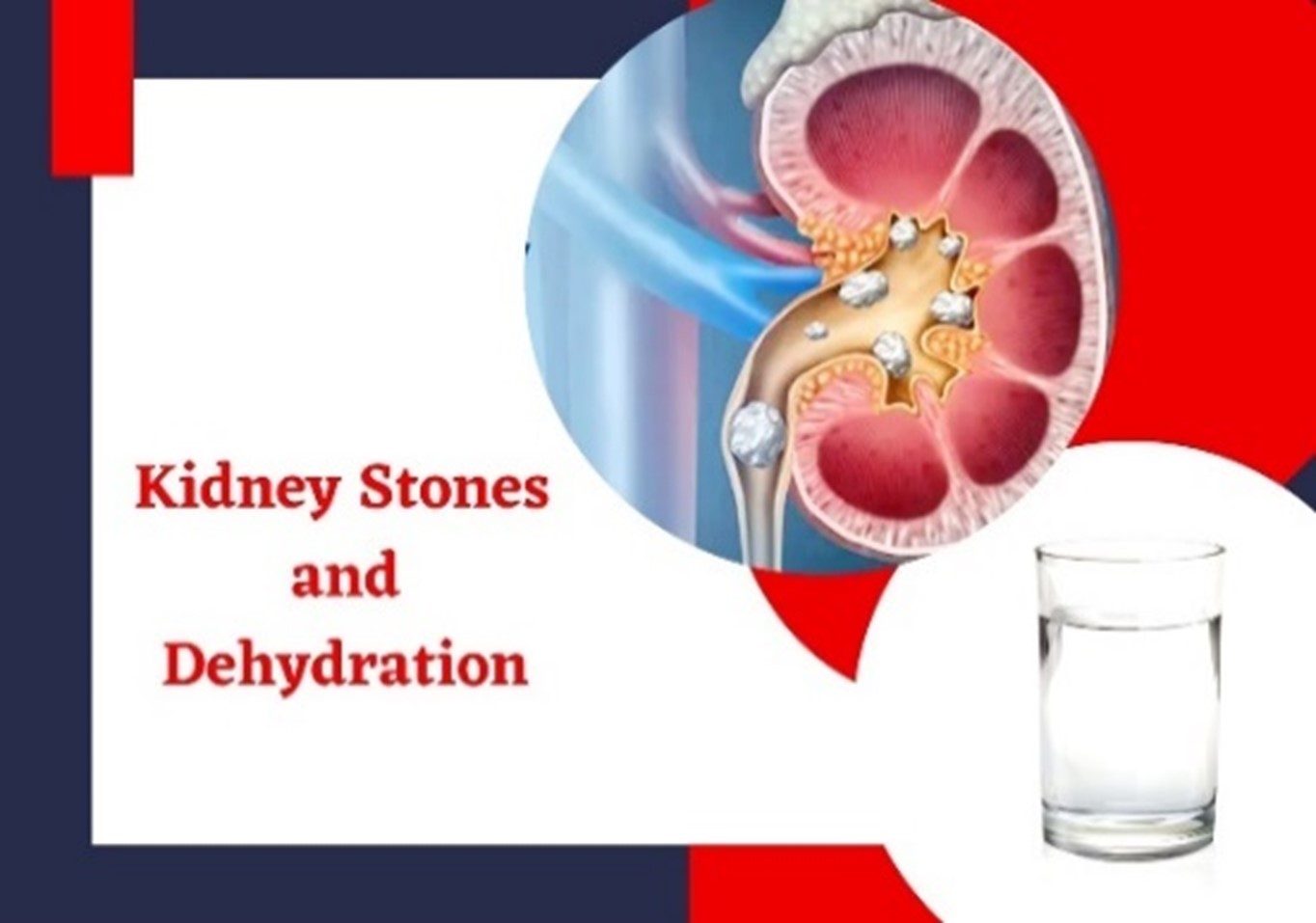 Kidney Stones & Dehydration